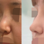 Kasus nyata revisi hidung karena infeksi (Klinik Bedah Plastik Gangnam)